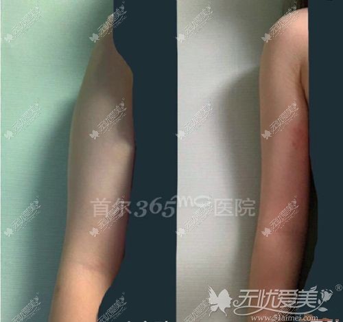 365mc兰斯手臂吸脂对比案例