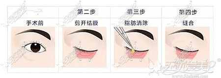 鸡西御美楼内切去眼袋的手术原理