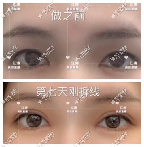 江涛医生的双眼皮修复案例