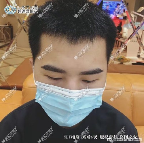 北京碧莲盛植眉效果