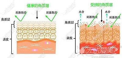 光子嫩肤可以修复受损角质层