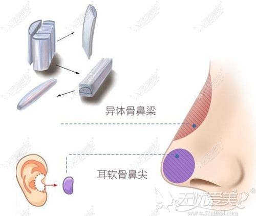 韩国异体骨隆鼻过程
