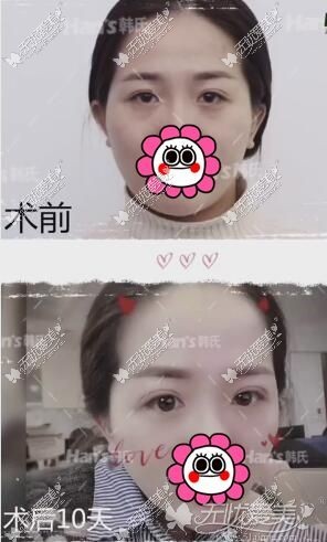 济南韩氏双眼皮修复案例