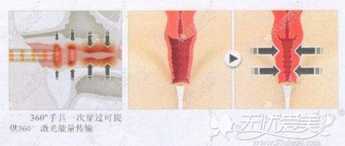 激光治疗缩阴原理