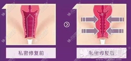 激光缩阴治疗后效果对比