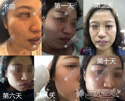 欧庙激光祛斑10天变化图片