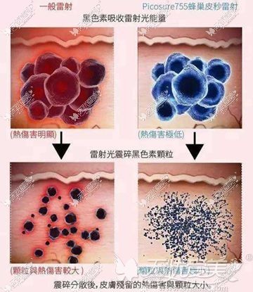 皮秒激光跟普通激光的对比