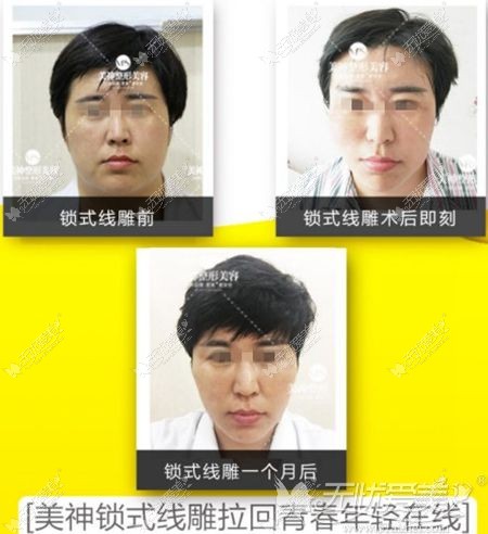 烟台美神面部线雕提升案例