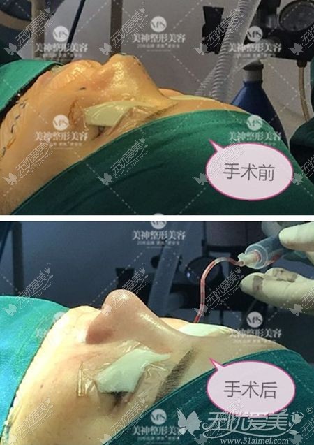 烟台美神鼻综合案例