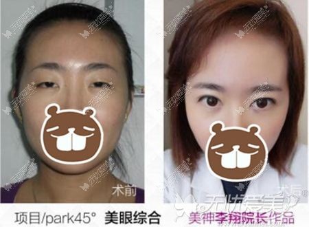 烟台美神眼综合案例