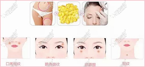 深圳鹏爱面部脂肪填充