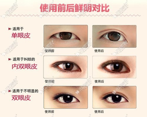 眼综合的效果