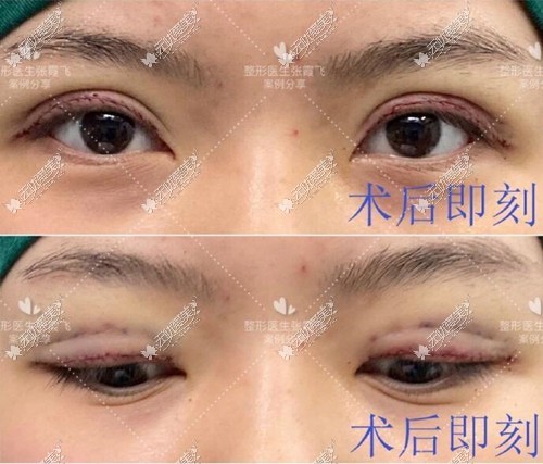 贝塞尔曲线双眼皮疤痕位置