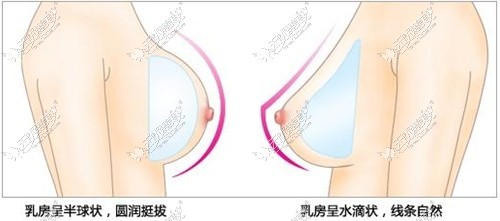 隆胸手术假体形状
