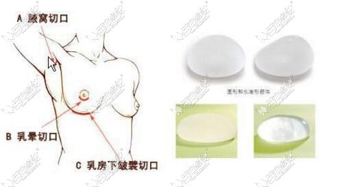 台州临海仁和假体隆胸切口