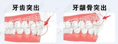 韩国菲斯莱茵整形医院突嘴手术做得好吗
