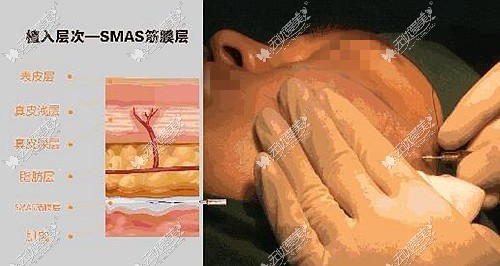 面部埋线提升的植入层次