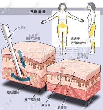 唐山金荣水动力吸脂