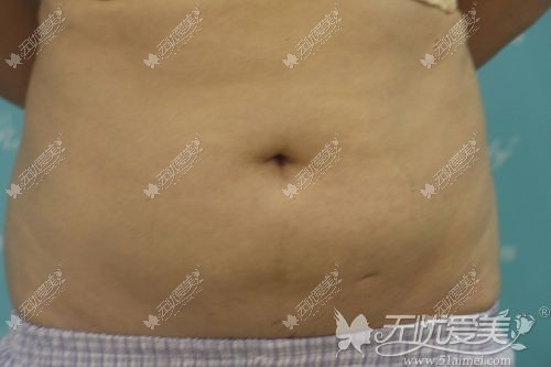 有了小肚子腰也在变粗