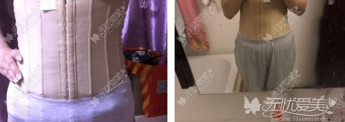 腰腹环吸后穿塑身衣的效果