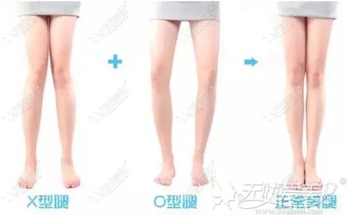 不完美的腿型