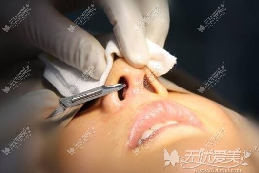 内江鼻整形修复 内江鼻整形修复