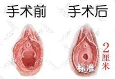 韩国好手艺妇科医院处女膜修复手术