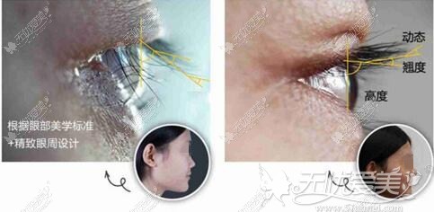 kep双眼皮术后能使睫毛上翘85°