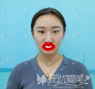 韩国李承焕双眼皮手术前