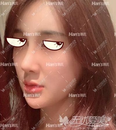 韩国李承焕隆鼻手术后