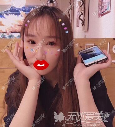 韩国李承焕双眼皮手术后