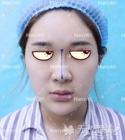 韩国李承焕隆鼻手术前