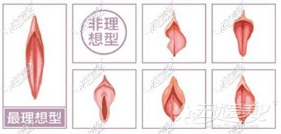 呼和浩特伊思阴唇整形