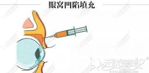 自体脂肪填充眼窝
