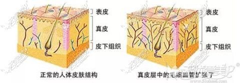真皮血管扩张