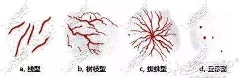 形成红血丝的几种类型