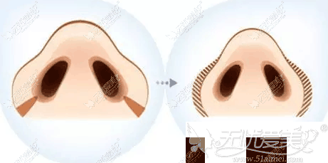 鼻翼缩小手术前后对比