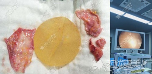 刘成胜采用内窥镜取出隆胸后假体的图片