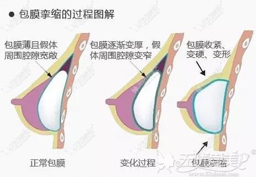 包膜挛缩的产生过程