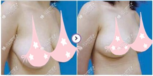胸下垂做乳房悬吊提升的效果