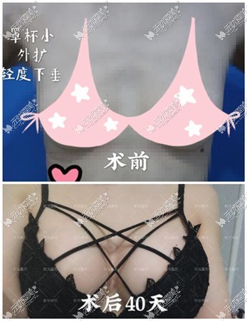 假体隆胸的效果