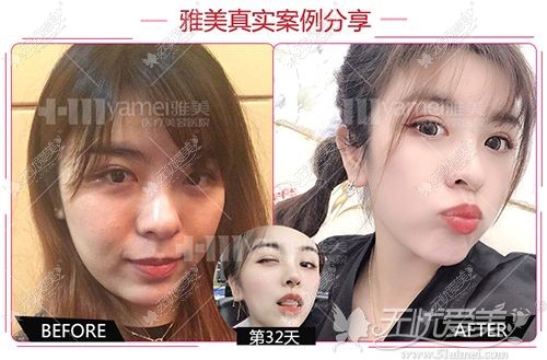 长沙雅美热玛吉面部对比案例