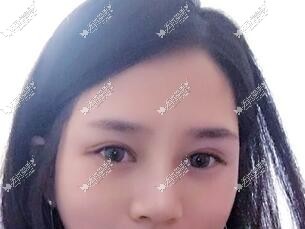 在成都武侯黄氏百佳医院【双眼皮+综合隆鼻】一个月照片