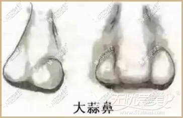 蒜头鼻大蒜鼻 蒜头鼻大蒜鼻