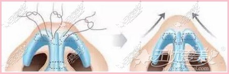 通辽京韩创美蒜头鼻矫正步骤 通辽京韩创美蒜头鼻矫正步骤