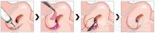 通辽京韩创美蒜头鼻矫正