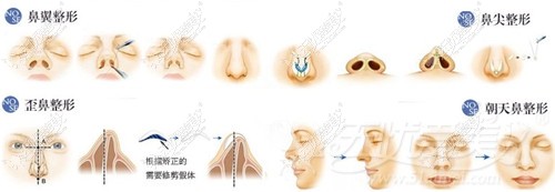 兰州亚韩整形医院鼻综合手术
