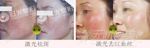 兰州时光整形医院激光美肤案例
