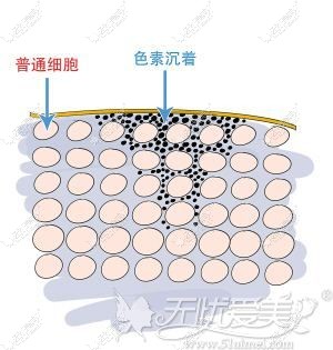 色素沉淀产生的原因