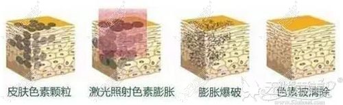 激光治疗色素沉淀原理